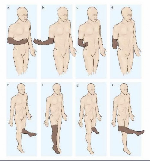 Fig. 1: Illustration of ‘paralyzed’ phantom limb sensations, Phantom Pain by Rebecca Brightwell via AgrAbility in Georgia (http://agrabilityinga.com/phantompain.html)  