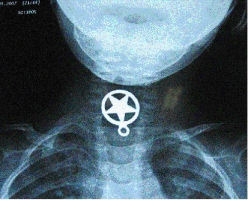 swallowed pendant